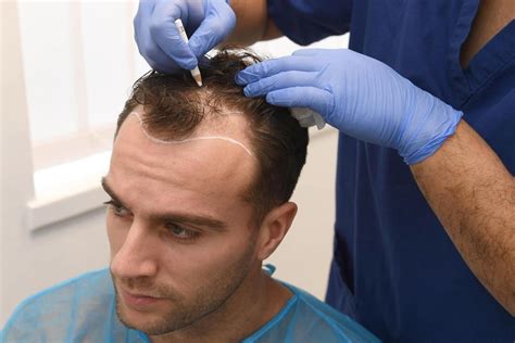 hair transplant near me